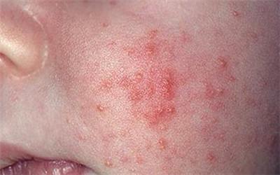 看看这是湿疹吗？原来很多宝妈都做错了！10种婴儿皮疹你知多少