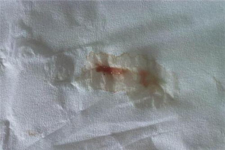 女性白带带血不能忽视的四个原因