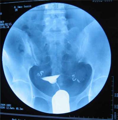 输卵管造影，女性备孕检查的第一道难关，真的疼痛难忍吗？