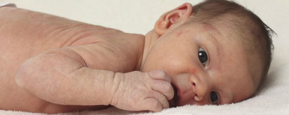 湿疹是秋季常见疾病 赶走湿疹可试试这些妙招