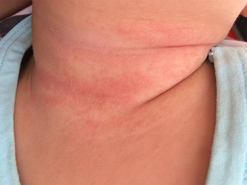 宝宝总是反复起大片湿疹,是胃肠功能弱导致免疫力低下,怎么办？