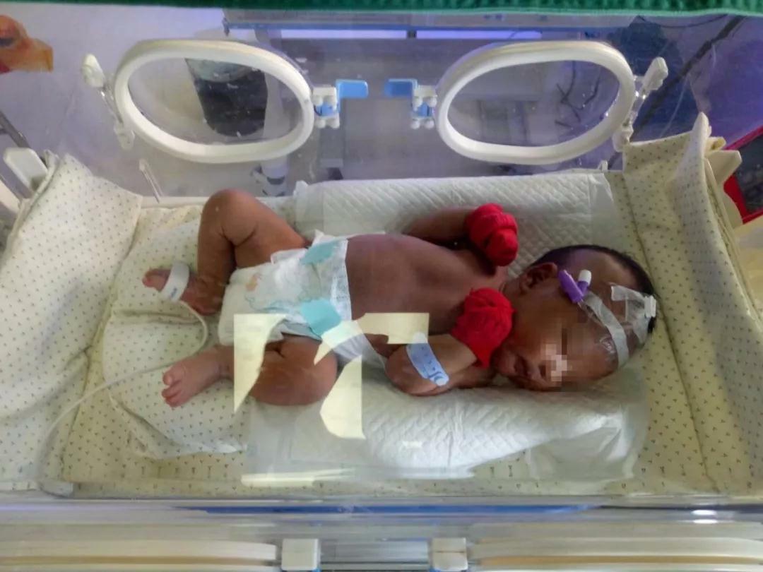 新生儿黄疸：色号不同,诊治不同