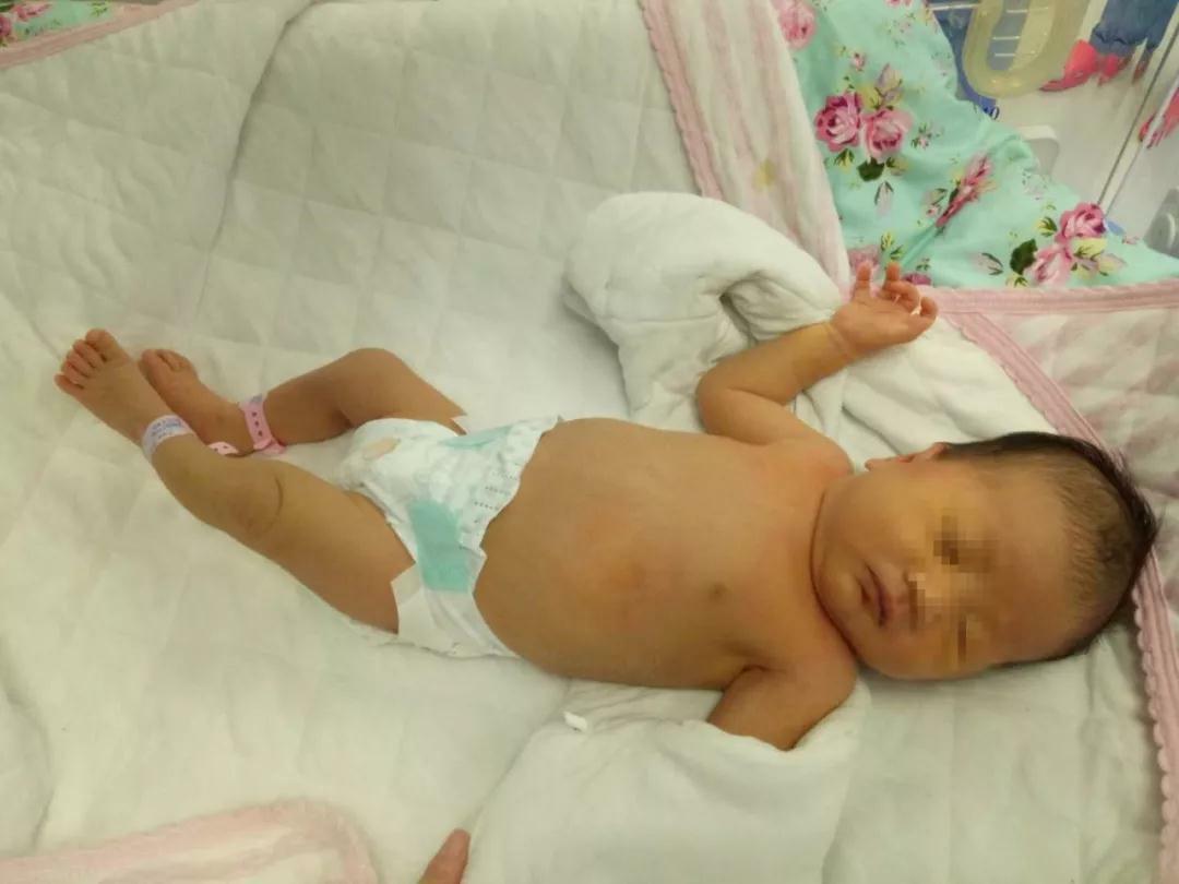 新生儿黄疸：色号不同,诊治不同