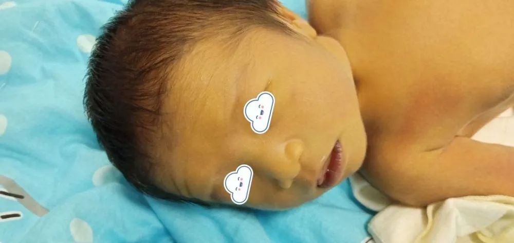 新生儿黄疸：色号不同,诊治不同