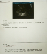 为啥怀孕后,医生要看有没有＂孕囊＂？多久才能看到？孕妈要清楚