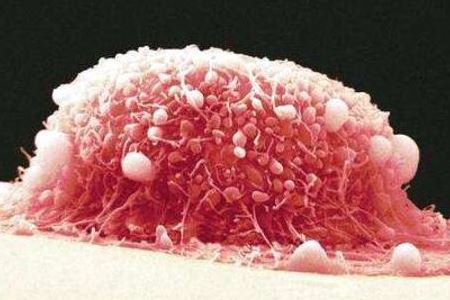 宫颈癌的常见表现以及治疗方法