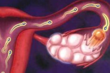 女人得卵巢囊肿的原因以及治疗方法