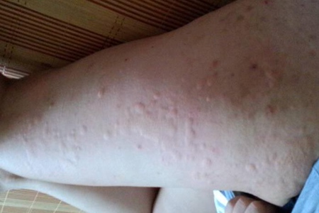 荨麻疹会传染吗？荨麻疹有哪些饮食禁忌