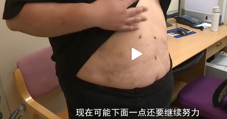 杭州400斤小伙缩胃减重100斤