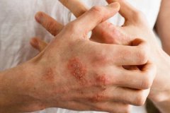 湿疹怎么治疗？这三个湿疹治疗有效的方法