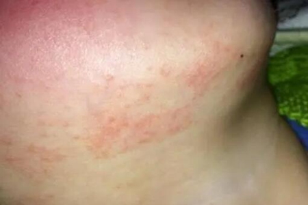 宝宝长湿疹怎么办？这四个方法护理是重点