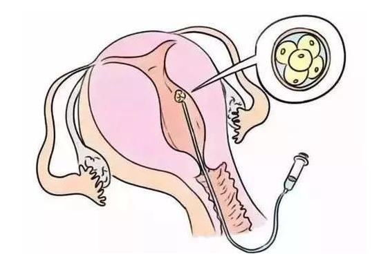 女人做了试管人就废了,哪些人做不了及注意事项