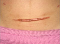 【剖腹产疤痕】剖腹产疤痕增生_剖腹产疤痕修复