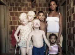 【白化病】白化病是什么_白化病是什么遗传方式