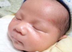 【新生儿痤疮】新生儿痤疮的症状_新生儿痤疮怎么办