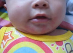 【宝宝过敏】宝宝过敏症状怎么办_宝宝过敏怎么办吃什么药