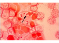 【脑膜炎】脑膜炎的症状_脑膜炎怎么治疗