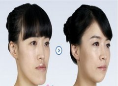 【地包天】幼儿地包天如何矫正_地包天什么时候矫正