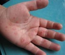 【小儿手足口病】小儿手足口病多久能好_儿童怎样预防手足口病