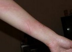 【猫抓病】猫抓病的症状_猫抓病怎么治疗