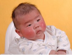 【小儿川崎病】宝宝川崎病的症状_川崎病的治疗及预后