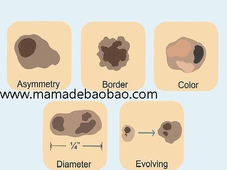 如何去除脸上的痣sugardvd（观察你的痣）