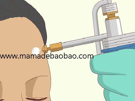 如何去除脸上的痣sugardvd（观察你的痣）