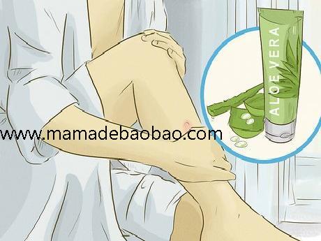 如何去除疤痕疙瘩: 9 步骤（天然疗法）