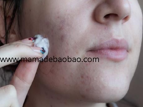 3种方法来去除粉刺（居家治疗）