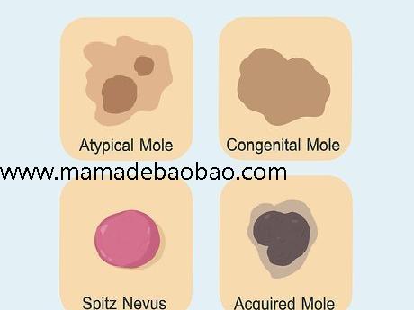 如何去除脸上的痣sugardvd（观察你的痣）