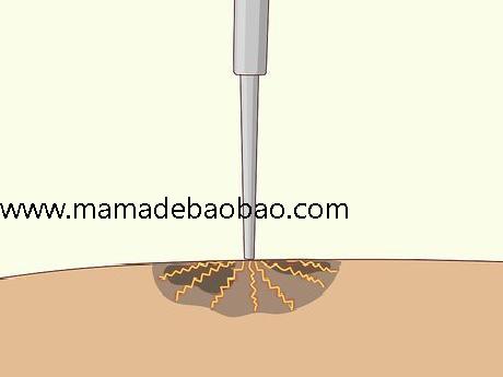 如何去除脸上的痣sugardvd（观察你的痣）